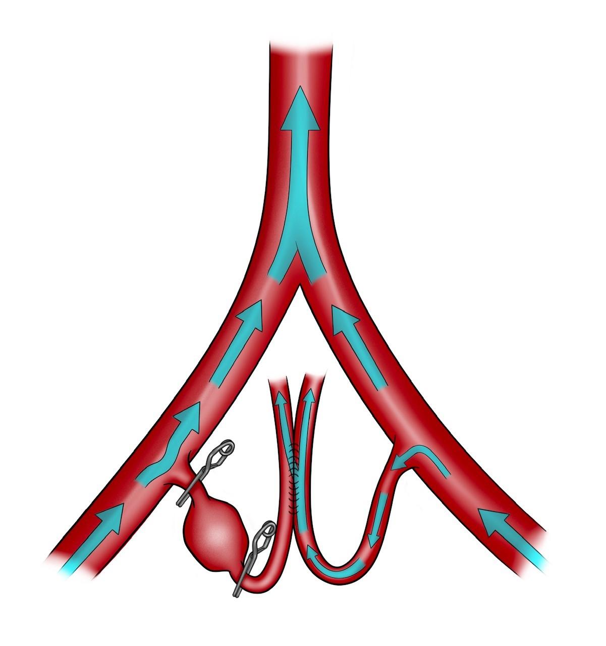 The PICA-PICA side-to-side bypass is illustrated here. (Illustration by Roberto C. Suazo/UTHealth Houston Neurosciences)
